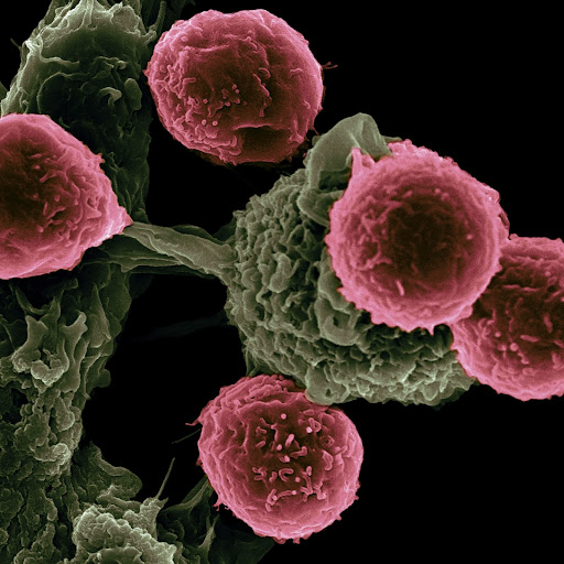 Death by Nanoparticles: Dr. Green’s Novel Approach to Cancer Treatment